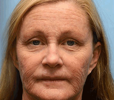 Rolimey® Botox & Vita A Retinol Shot Wrinkle-Lift Tightening cream