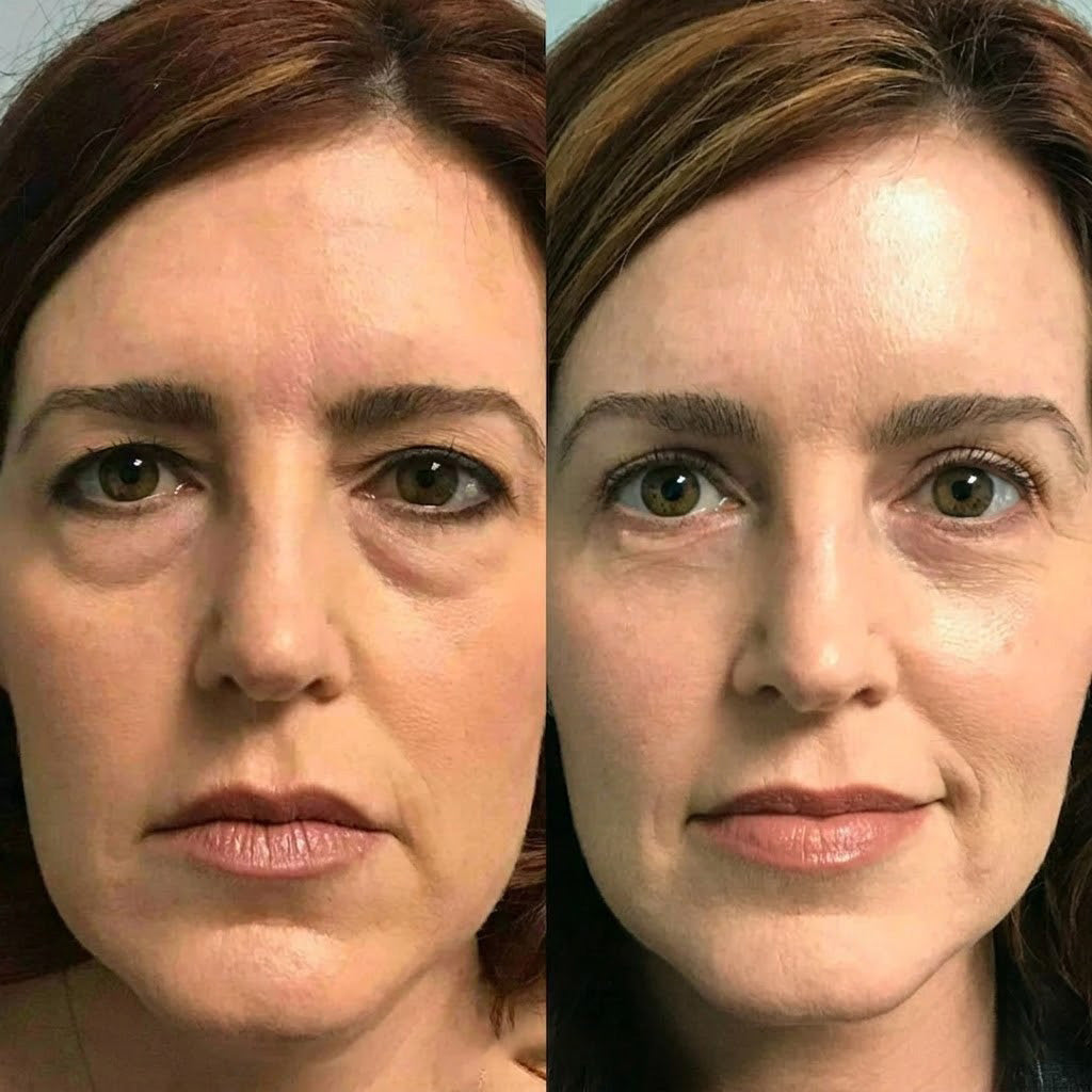 Rolimey® Botox & Vita A Retinol Shot Wrinkle-Lift Tightening cream