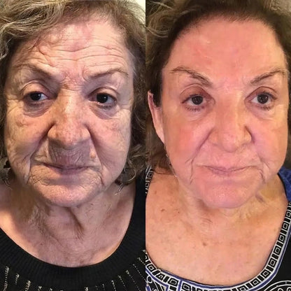 Rolimey® Botox & Vita A Retinol Shot Wrinkle-Lift Tightening cream